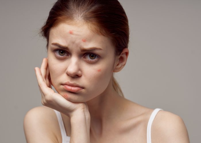 Mụn trứng cá ở tuổi dậy thì phải làm sao?