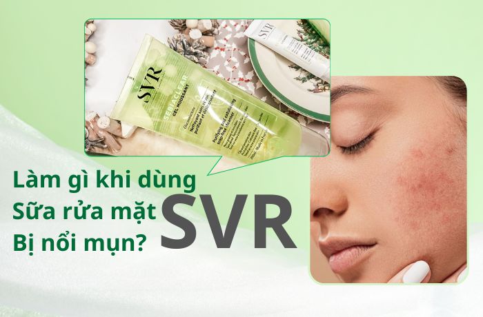 Làm gì khi dùng sữa rửa mặt SVR bị nổi mụn?
