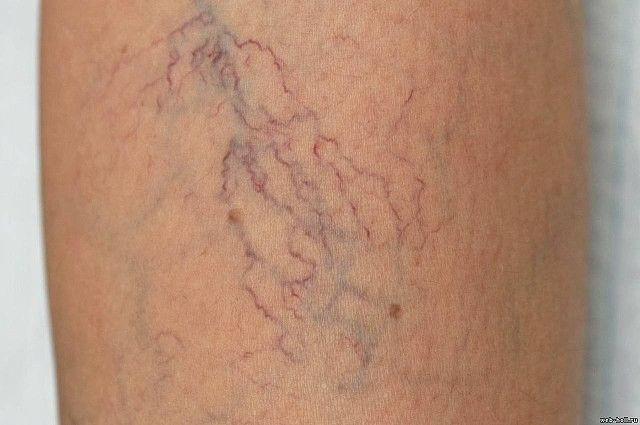 Dấu hiệu nhận biết giãn tĩnh mạch chân ở mẹ bầu