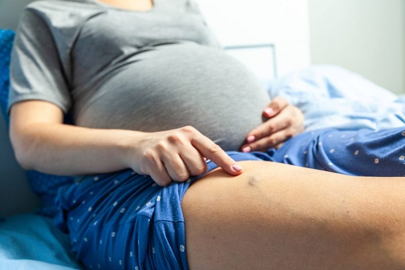 Nổi gân xanh khi mang thai có nguy hiểm không